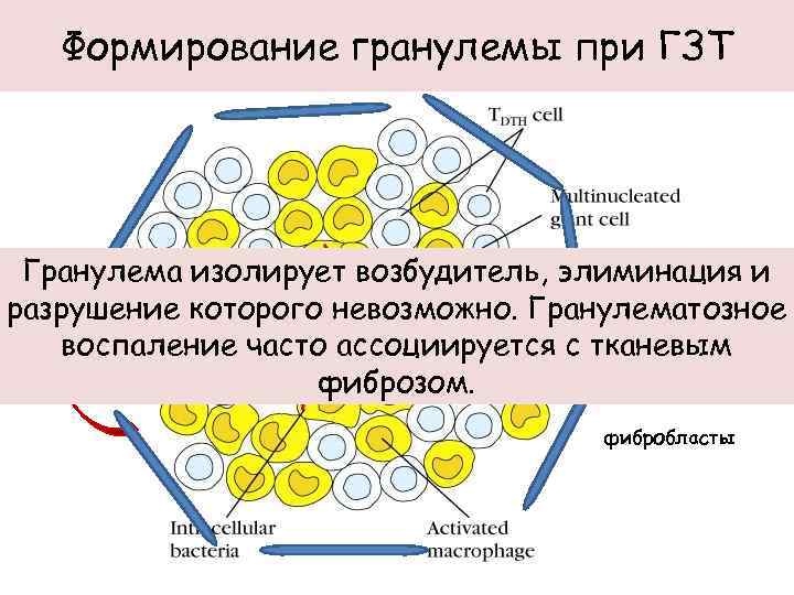 Формирование гранулемы при ГЗТ Гранулема изолирует возбудитель, элиминация и TNF-α разрушение которого невозможно. Гранулематозное