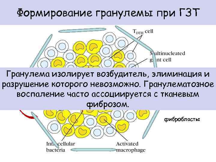 Формирование гранулемы при ГЗТ Гранулема изолирует возбудитель, элиминация и TNF-α разрушение которого невозможно. Гранулематозное