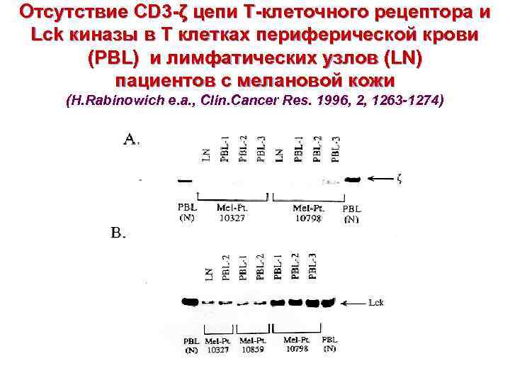 Отсутствие CD 3 -ζ цепи Т-клеточного рецептора и Lck киназы в Т клетках периферической