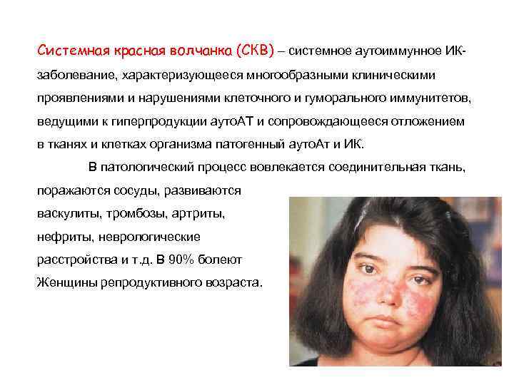 Системная красная волчанка (СКВ) – системное аутоиммунное ИКзаболевание, характеризующееся многообразными клиническими проявлениями и нарушениями
