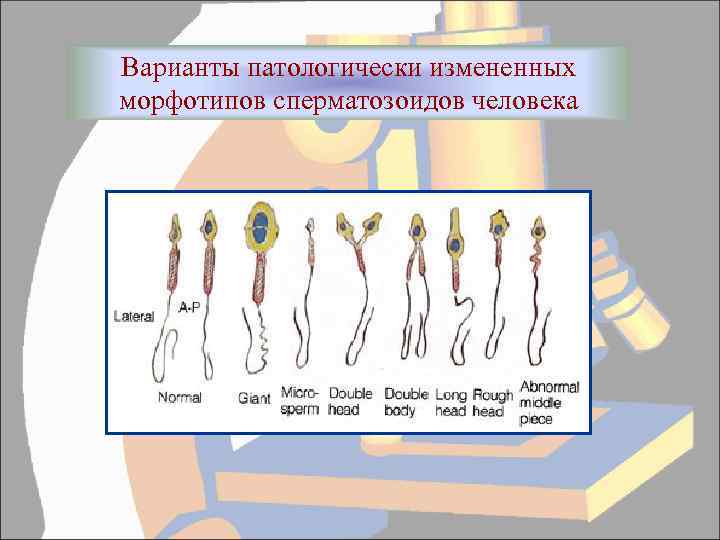 Варианты патологически измененных морфотипов сперматозоидов человека 