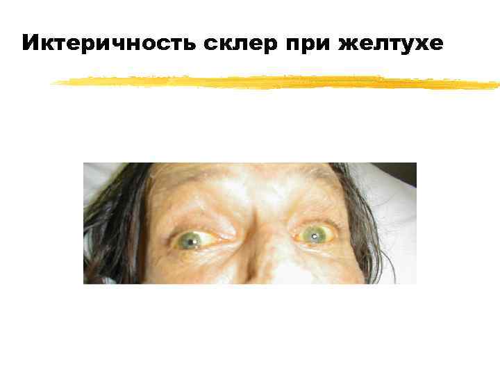 Иктеричность склер при желтухе 