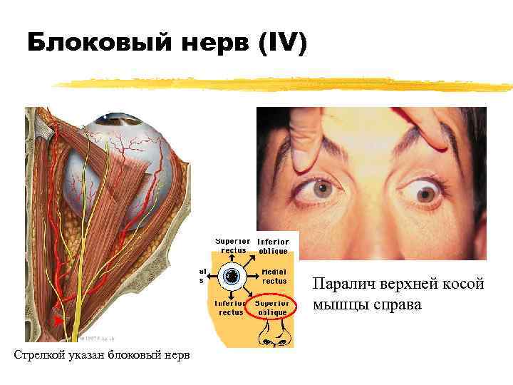 Блоковый нерв (IV) Паралич верхней косой мышцы справа Стрелкой указан блоковый нерв 