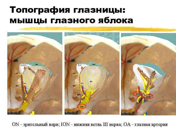 Топография глазницы: мышцы глазного яблока ON - зрительный нерв; ION - нижняя ветвь III