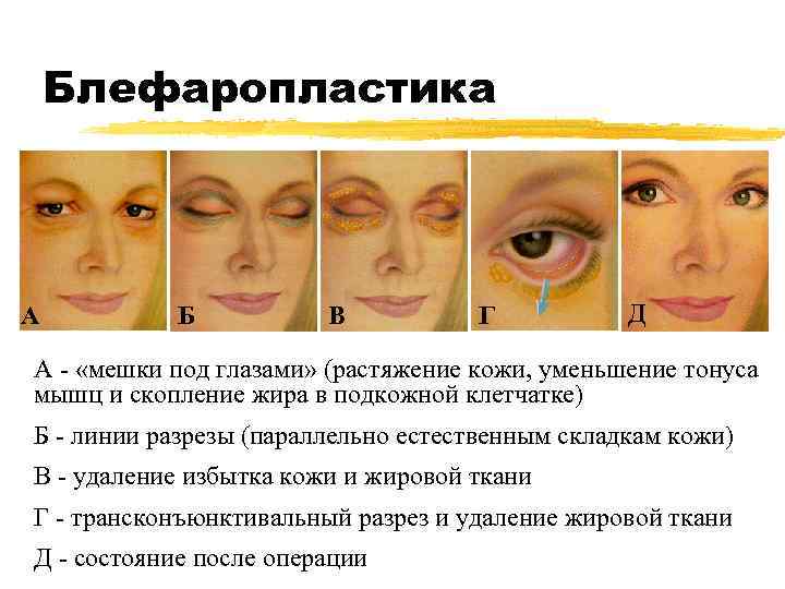Блефаропластика А Б В Г Д А - «мешки под глазами» (растяжение кожи, уменьшение