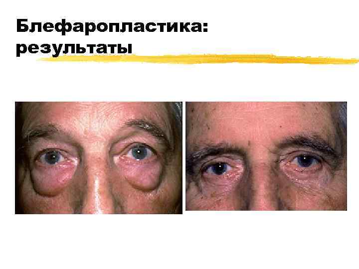 Блефаропластика: результаты 