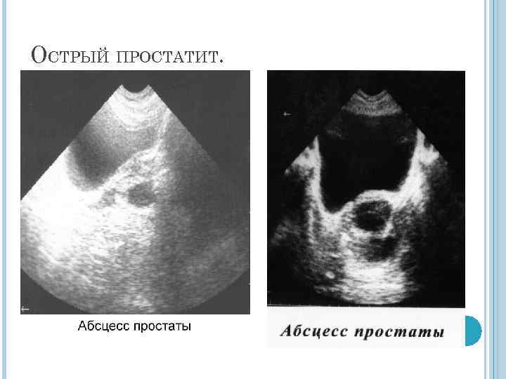 ОСТРЫЙ ПРОСТАТИТ. 