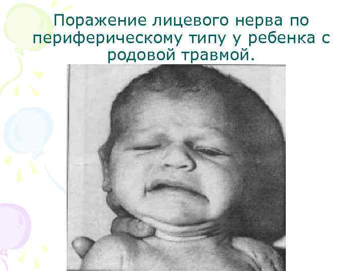 Поражение лицевого нерва по периферическому типу у ребенка с родовой травмой. 