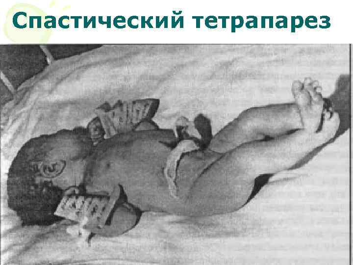 Спастический тетрапарез 