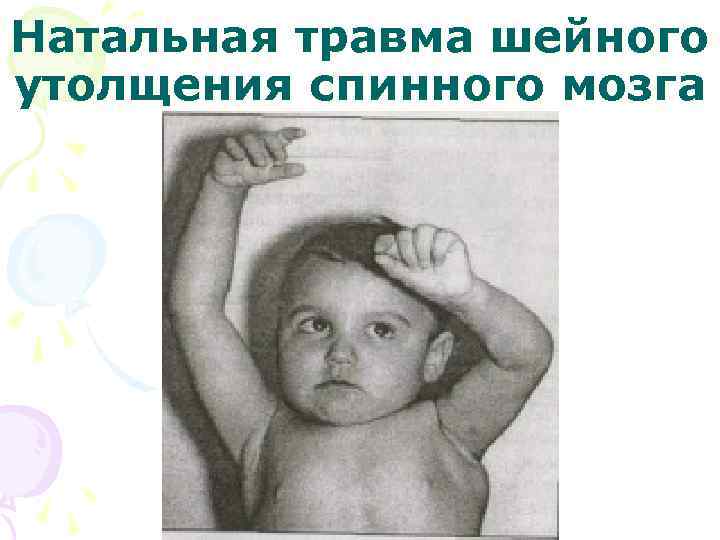 Натальная травма шейного утолщения спинного мозга 