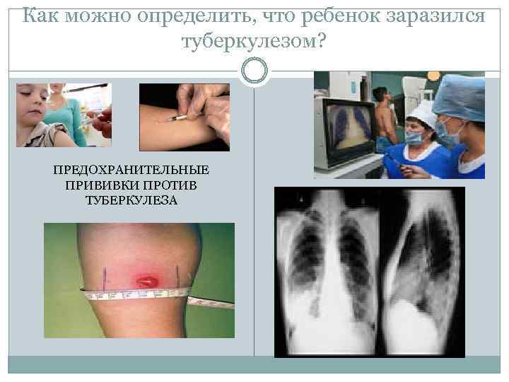 Как можно определить, что ребенок заразился туберкулезом? ПРЕДОХРАНИТЕЛЬНЫЕ ПРИВИВКИ ПРОТИВ ТУБЕРКУЛЕЗА 