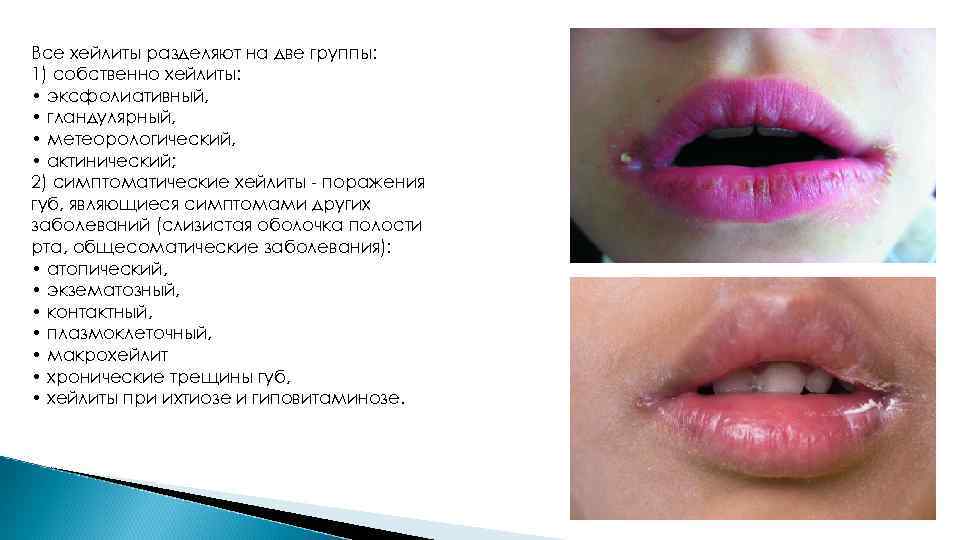 Все хейлиты разделяют на две группы: 1) собственно хейлиты: • эксфолиативный, • гландулярный, •