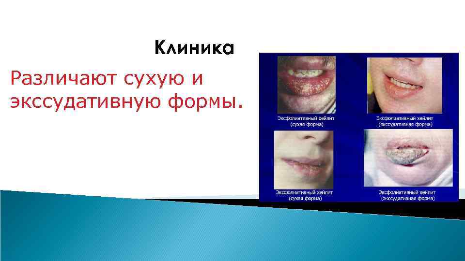 Клиника Различают сухую и экссудативную формы. 