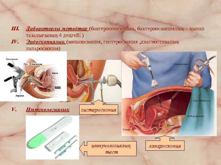 III. IV. Лабораторлы методтар (бактериологиялық, бактериоскопиялық – қынап тазалығының 4 деңгейі ) Эндоскопиялық (кольпоскопия,
