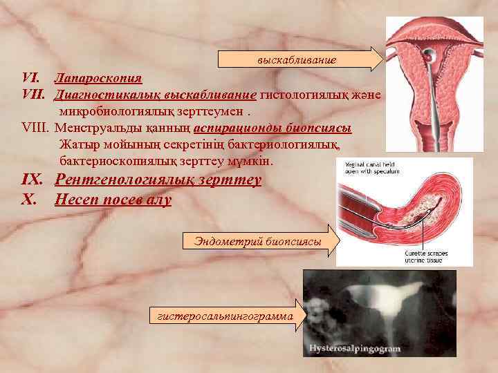 выскабливание VI. Лапароскопия VII. Диагностикалық выскабливание гистологиялық және микробиологиялық зерттеумен. VIII. Менструальды қанның аспирационды