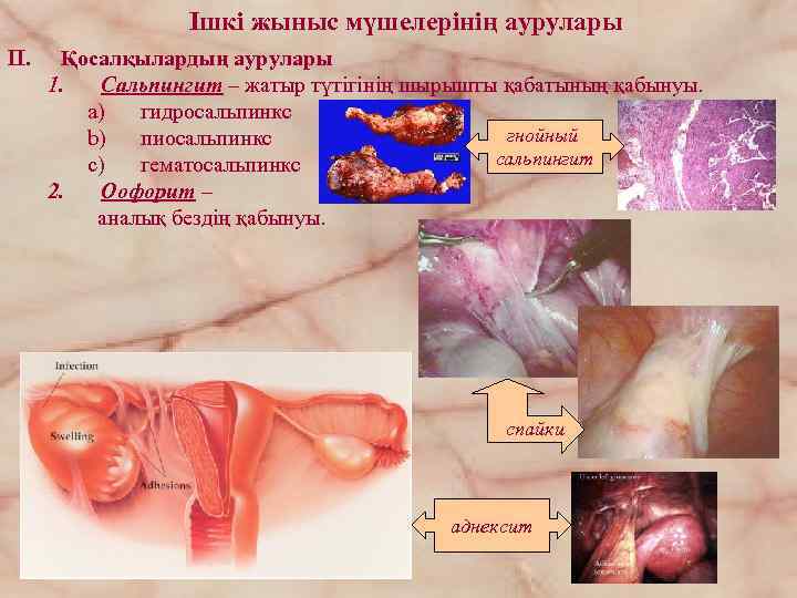 Iшкі жыныс мүшелерінің аурулары II. Қосалқылардың аурулары 1. Сальпингит – жатыр түтігінің шырышты қабатының