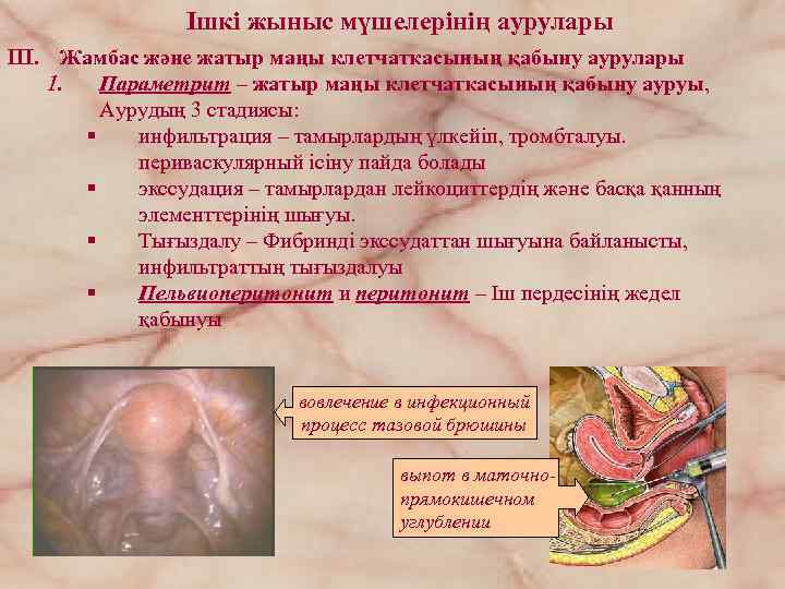 Iшкі жыныс мүшелерінің аурулары III. Жамбас және жатыр маңы клетчаткасының қабыну аурулары 1. Параметрит