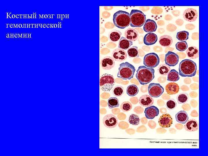 Костный мозг при гемолитической анемии 