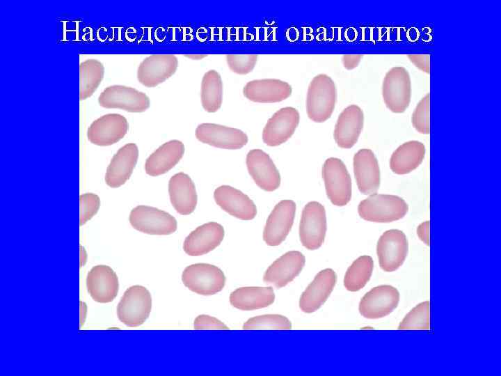 Наследственный овалоцитоз 
