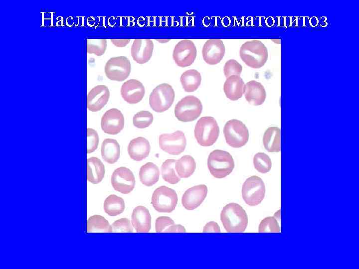 Наследственный стоматоцитоз 