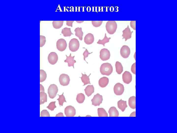 Акантоцитоз 