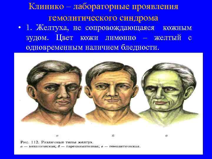 Клинико – лабораторные проявления гемолитического синдрома • 1. Желтуха, не сопровождающаяся кожным зудом. Цвет