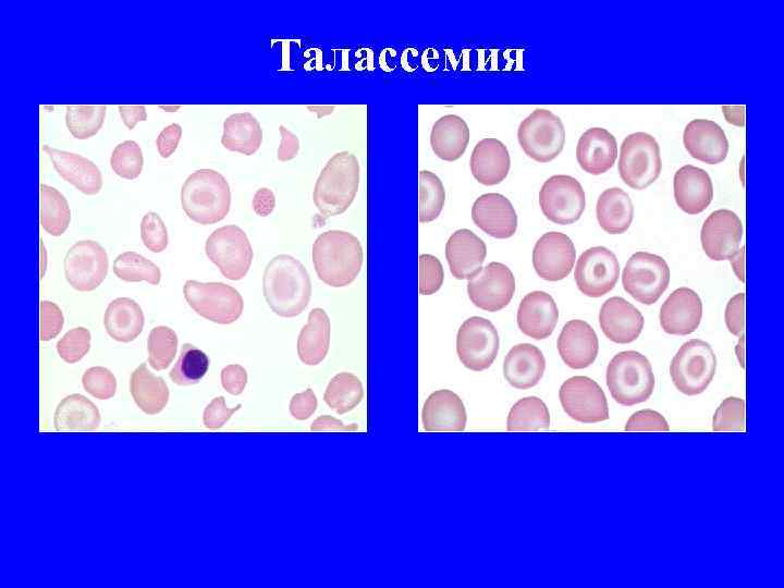 Талассемия 