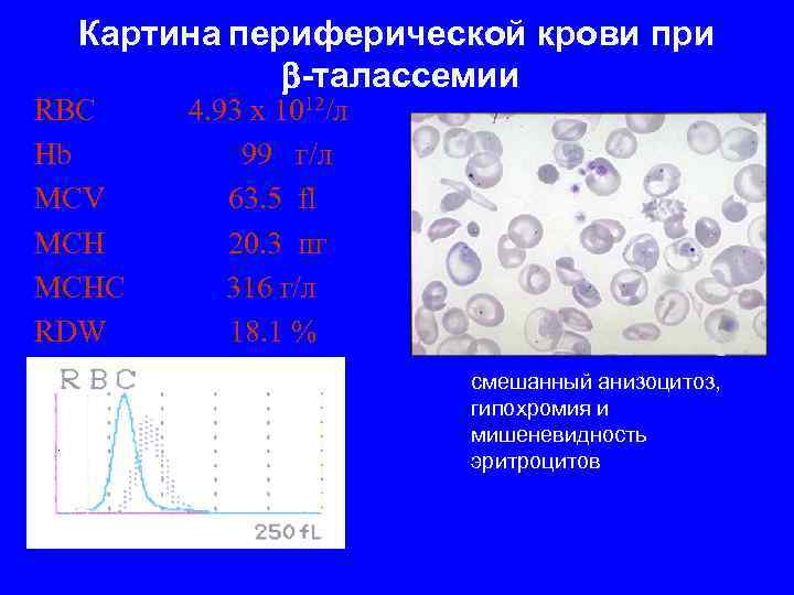 Картина периферической крови при -талассемии RBC 4. 93 x 1012/л Hb 99 г/л MCV