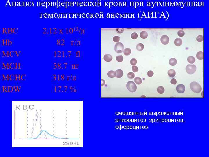 Анализ периферической крови при аутоиммунная гемолитической анемии (АИГА) RBC 2. 12 x 1012/л Hb