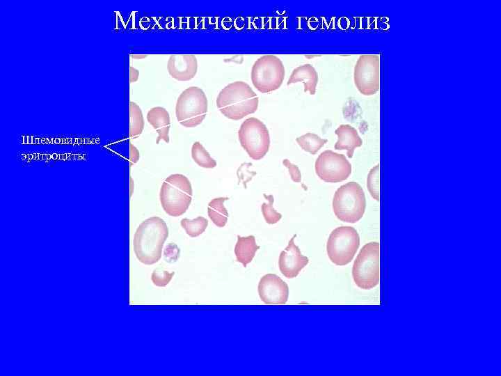 Механический гемолиз Шлемовидные эритроциты 