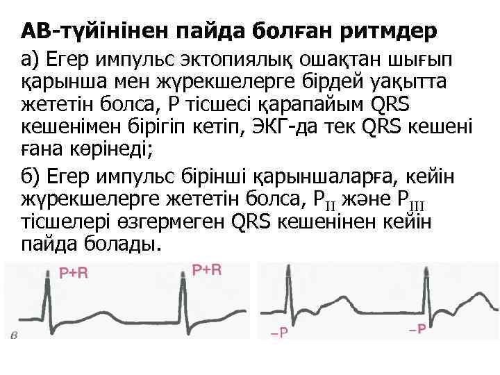 АВ-түйінінен пайда болған ритмдер а) Егер импульс эктопиялық ошақтан шығып қарынша мен жүрекшелерге бірдей