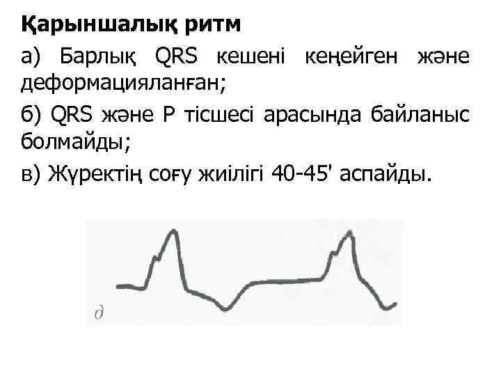 Қарыншалық ритм а) Барлық QRS кешені кеңейген және деформацияланған; б) QRS және Р тісшесі