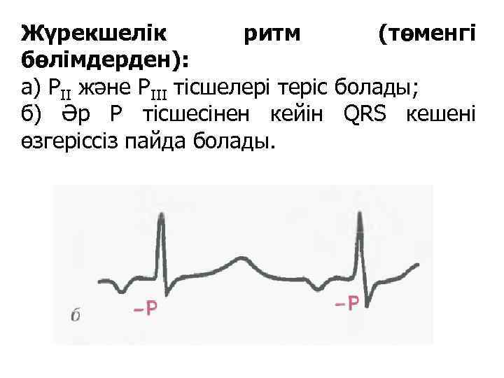 Жүрекшелік ритм (төменгі бөлімдерден): а) РІІ және РІІІ тісшелері теріс болады; б) Әр Р
