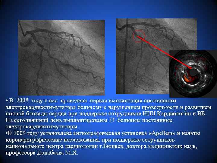  • В 2008 году у нас проведена первая имплантация постоянного электрокардиостимулятора больному с
