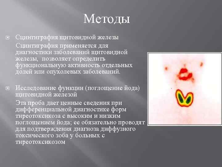 Методы Сцинтиграфия щитовидной железы Сцинтиграфия применяется для диагностики заболеваний щитовидной железы, позволяет определить функциональную