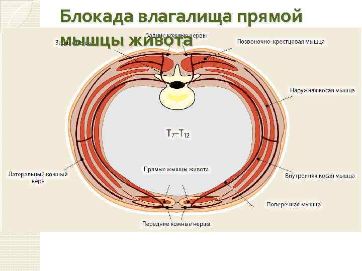 Блокада влагалища прямой мышцы живота 