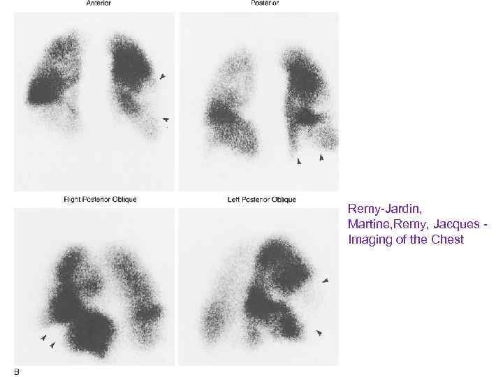 Remy-Jardin, Martine, Remy, Jacques - Imaging of the Chest 