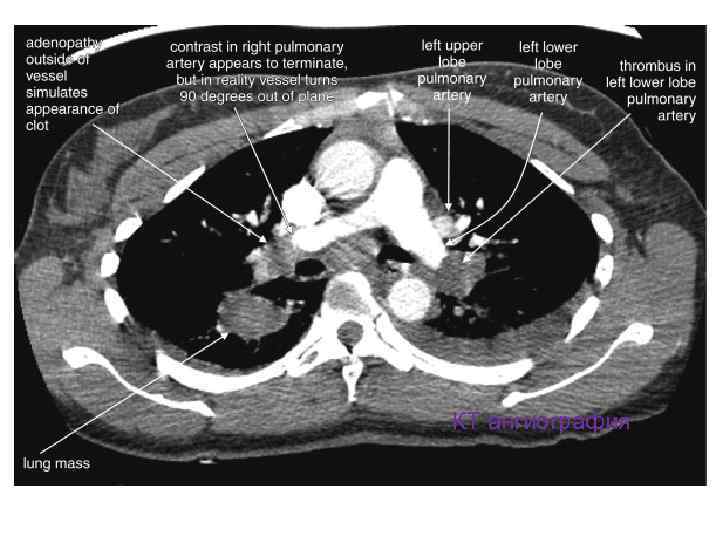 КТ ангиография 