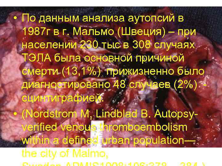  • По данным анализа аутопсий в 1987 г в г. Мальмо (Швеция) –