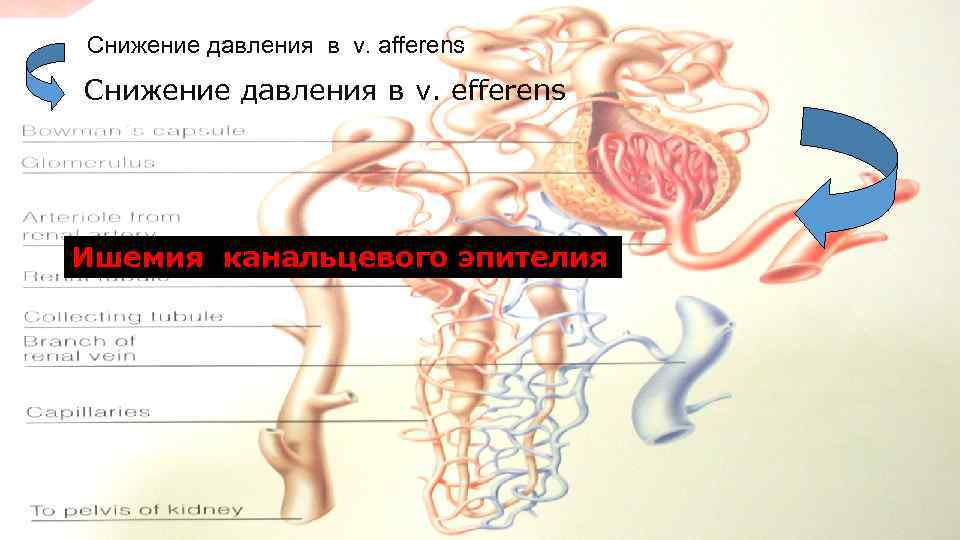 Снижение давления в v. afferens Снижение давления в v. efferens Ишемия канальцевого эпителия 