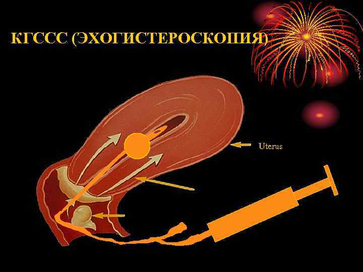 КГССС (ЭХОГИСТЕРОСКОПИЯ) Uterus 