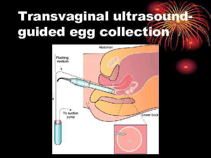 Transvaginal ultrasoundguided egg collection 