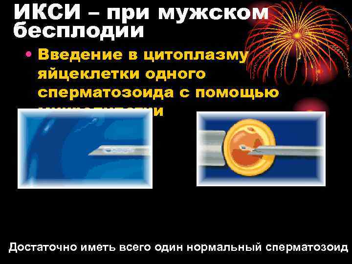 ИКСИ – при мужском бесплодии • Введение в цитоплазму яйцеклетки одного сперматозоида с помощью