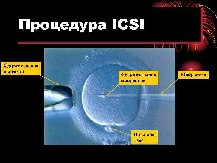 Процедура ICSI Удерживающая присоска Сперматозоид в микроигле Полярное тело Микроигла 