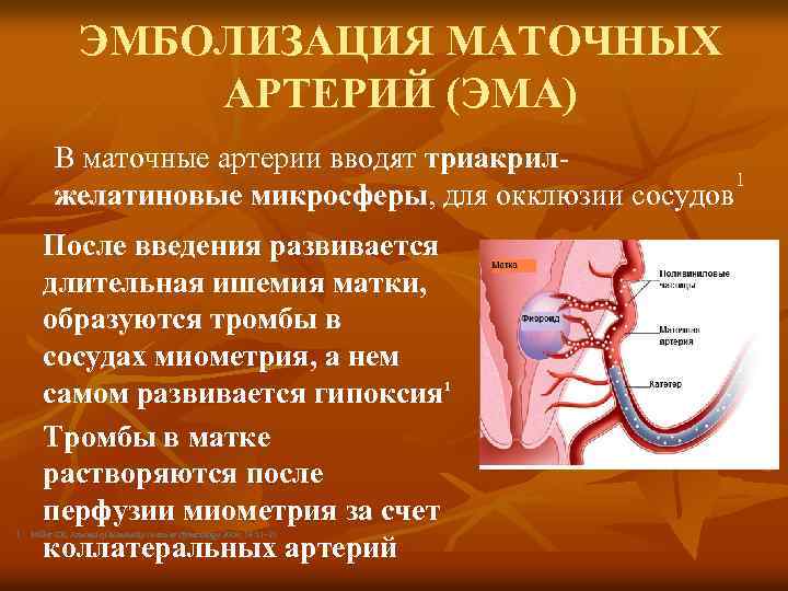 ЭМБОЛИЗАЦИЯ МАТОЧНЫХ АРТЕРИЙ (ЭМА) В маточные артерии вводят триакрил 1 желатиновые микросферы, для окклюзии