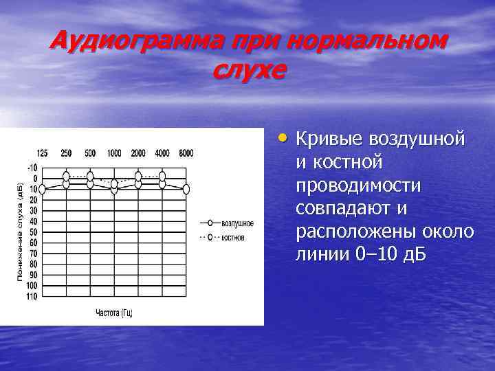 Аудиограмма при нормальном слухе • Кривые воздушной и костной проводимости совпадают и расположены около