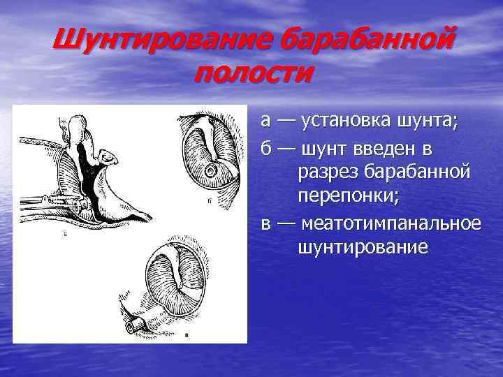 Шунтирование барабанной полости а — установка шунта; б — шунт введен в разрез барабанной