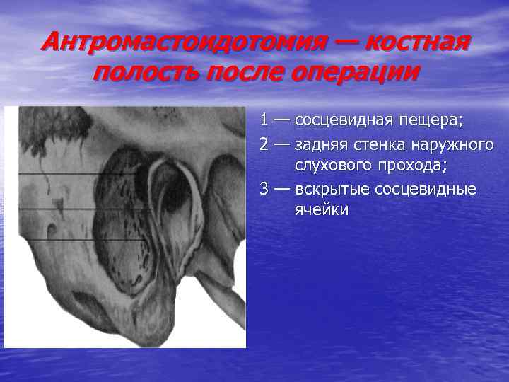 Антромастоидотомия — костная полость после операции 1 — сосцевидная пещера; 2 — задняя стенка