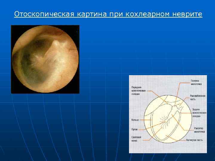 Отоскопическая картина при кохлеарном неврите 