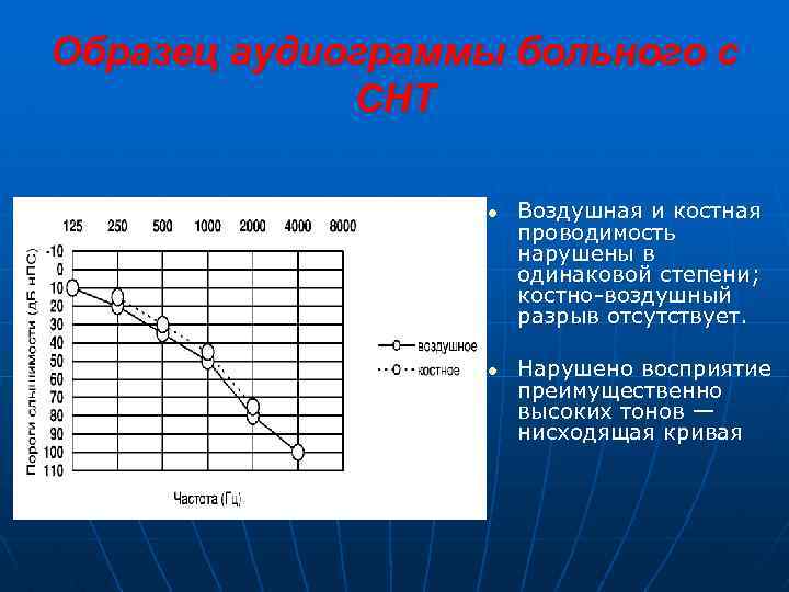 Образец аудиограммы больного с СНТ Воздушная и костная проводимость нарушены в одинаковой степени; костно-воздушный